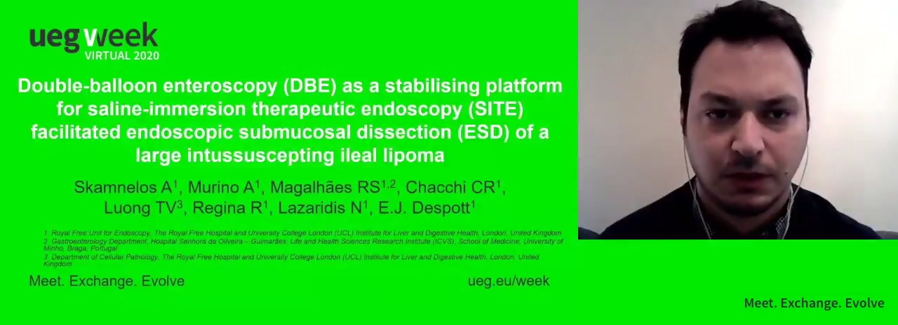 DOUBLE-BALLOON ENTEROSCOPY (DBE) AS A STABILISING PLATFORM FOR SALINE-IMMERSION THERAPEUTIC ENDOSCOPY (SITE) FACILITATED ENDOSCOPIC SUBMUCOSAL DISSECTION (ESD) OF A LARGE, INTUSSUSCEPTING ILEAL LIPOMA