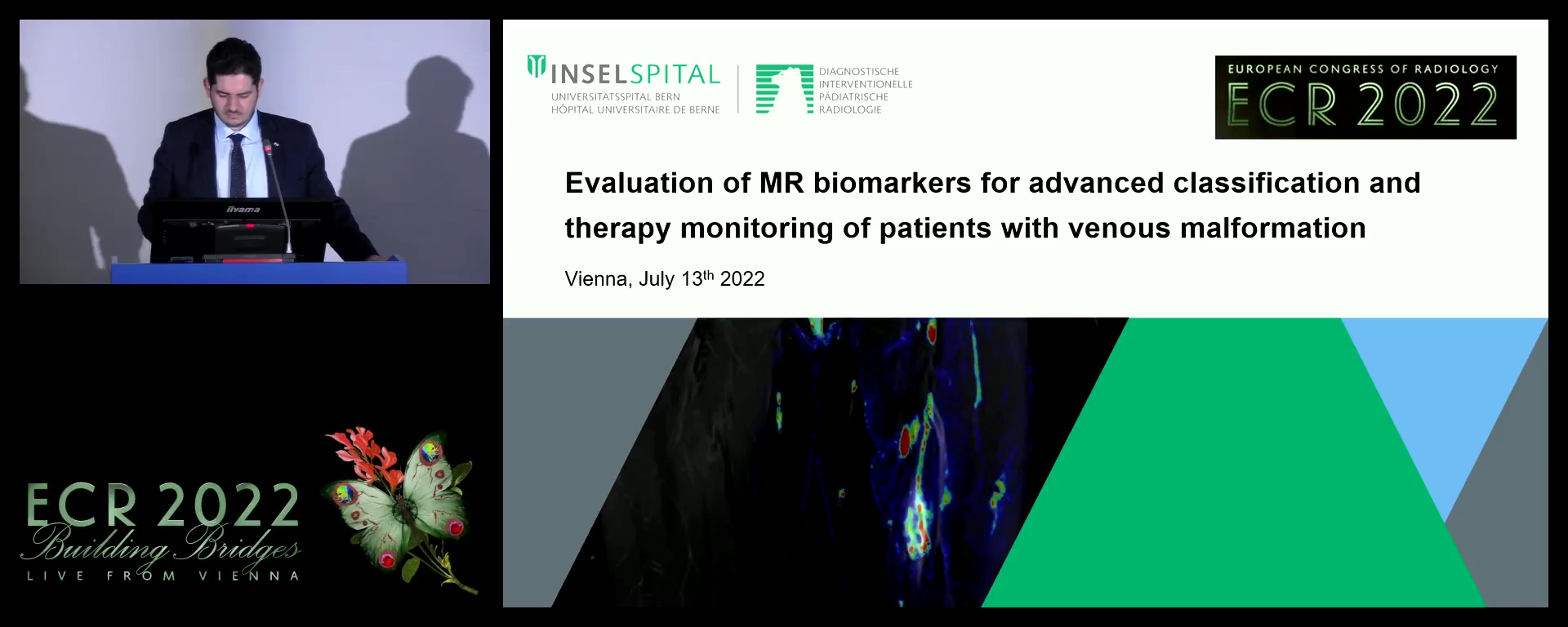 Evaluation of MR biomarkers for advanced classification and therapy monitoring of patients with venous malformation