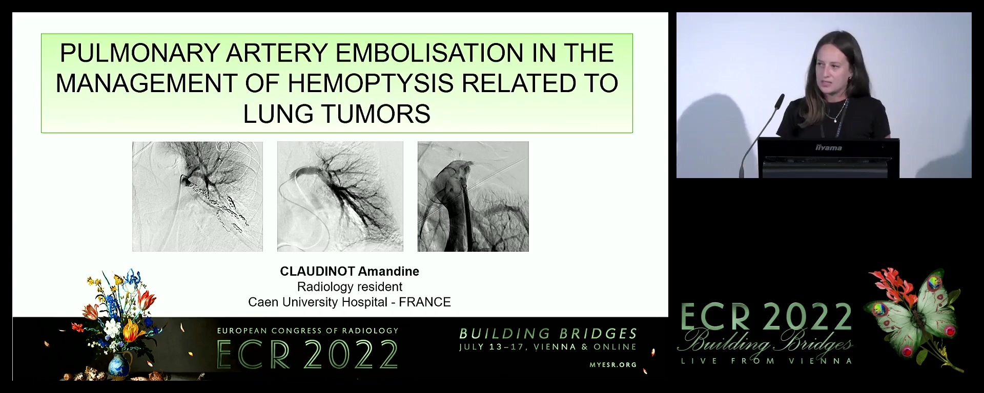 Pulmonary artery embolisation in the management of hemoptysis related to lung tumours