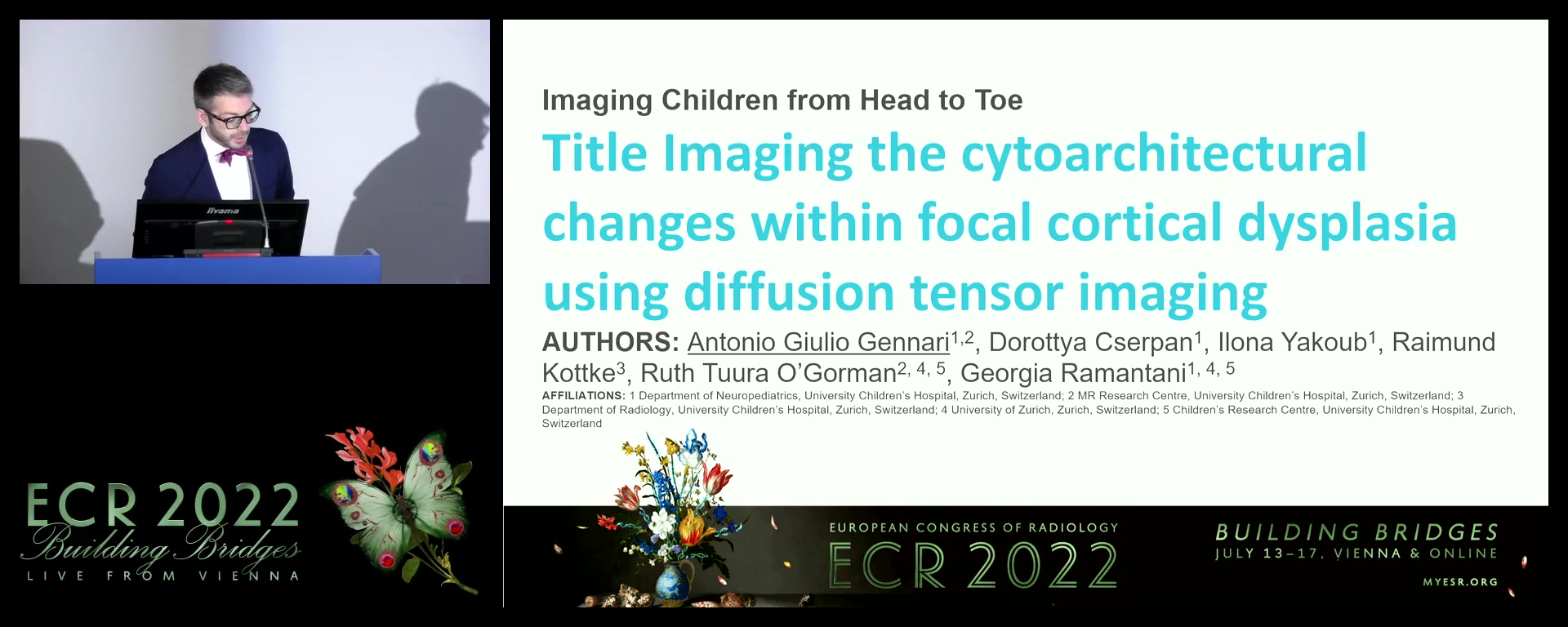 Imaging cytoarchitectural changes within focal cortical dysplasia using diffusion tensor imaging - Antonio Giulio Gennari, Zurich / IT