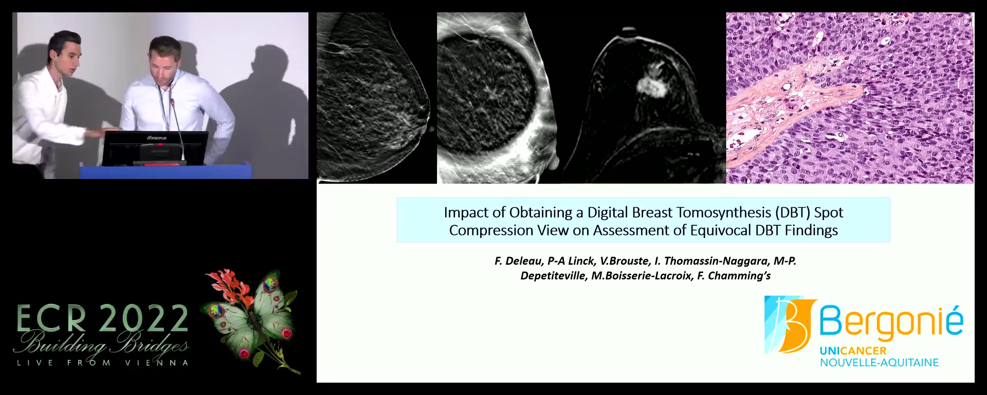 Impact of obtaining a digital breast tomosynthesis (DBT) spot compression view on assessment of equivocal DBT findings