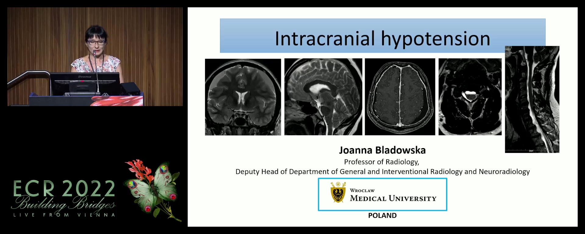 Intracranial hypotension