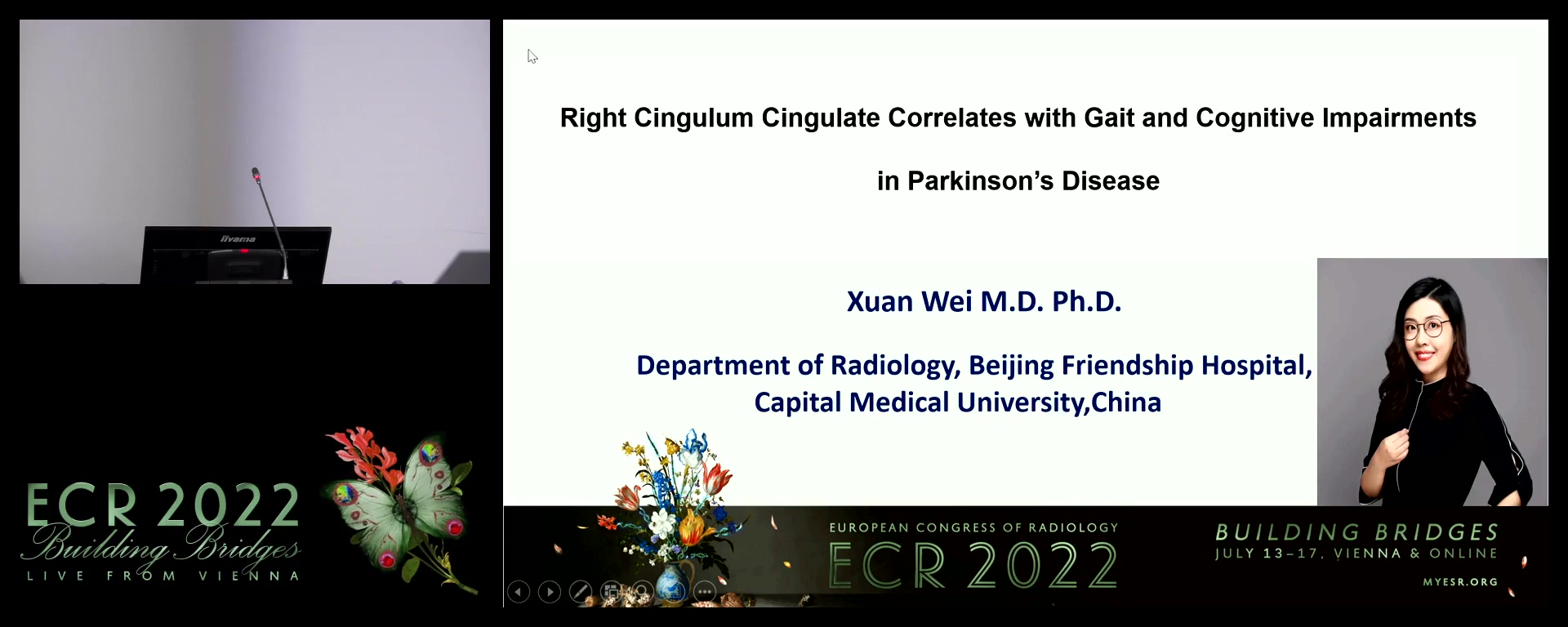 Right cingulum cingulate correlates with gait and cognitive impairments in Parkinson’s disease