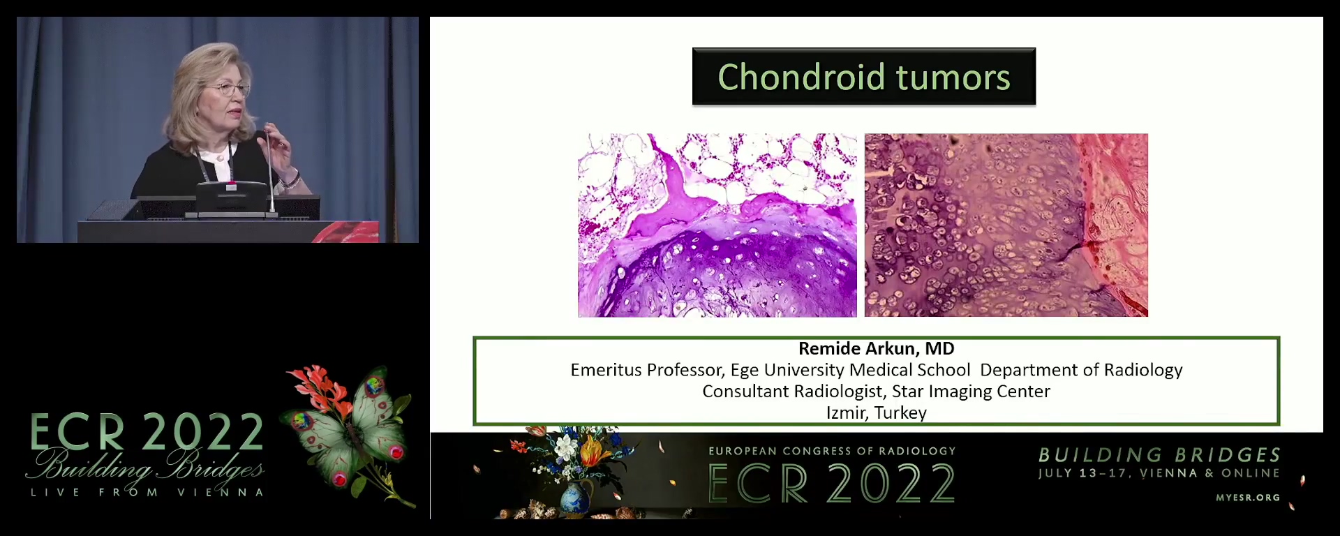 Chondroid tumours - Remide Arkun, Izmir / TR