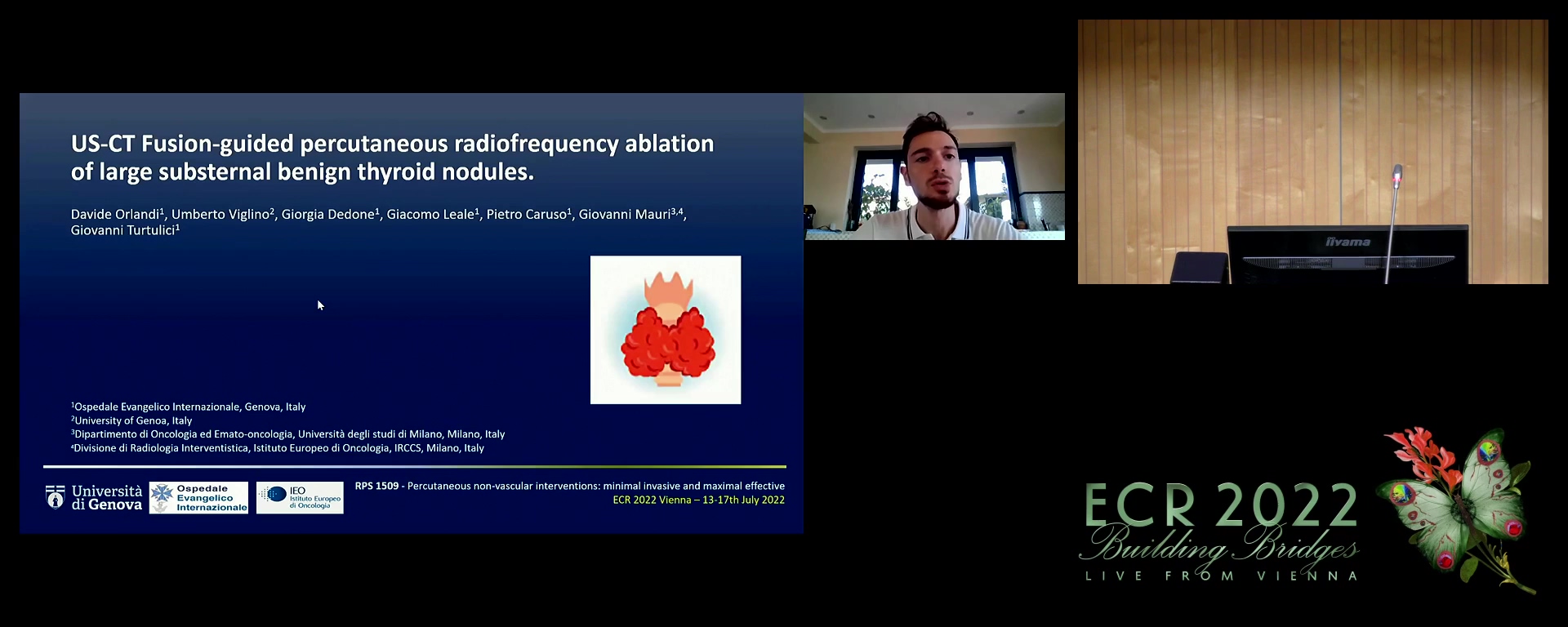 US-CT fusion-guided percutaneous radiofrequency ablation of large substernal benign thyroid nodules - Umberto Viglino, Genoa / IT