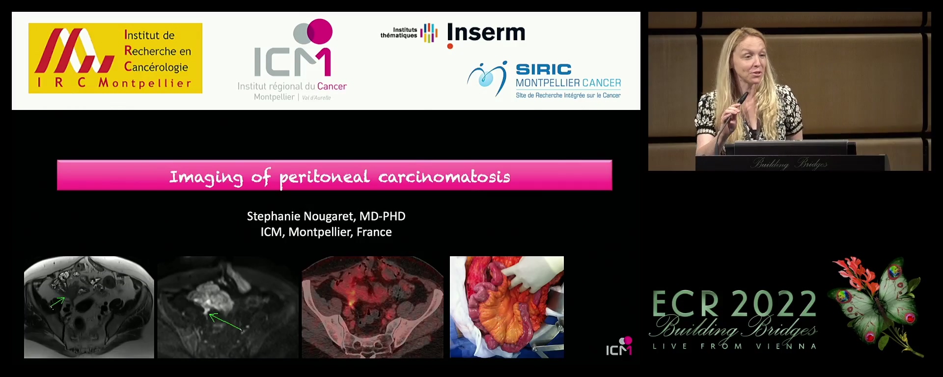 Imaging of peritoneal carcinomatosis