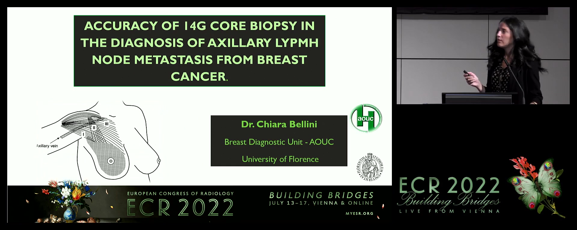 Accuracy of 14G core biopsy in the diagnosis of axillary lymph node metastasis from breast cancer