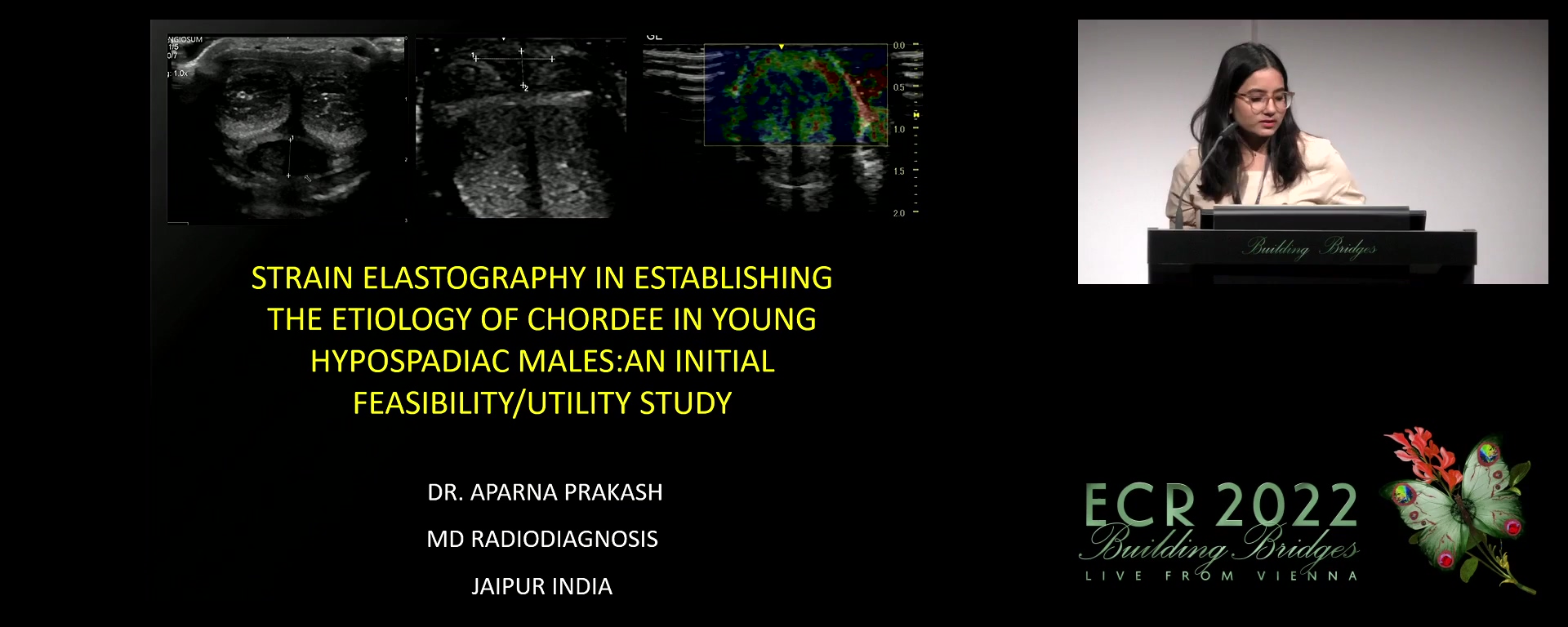 Strain elastography in establishing the aetiology of chordee in young hypospadiac males: a work in progress report - Aparna Prakash, Jaipur / IN