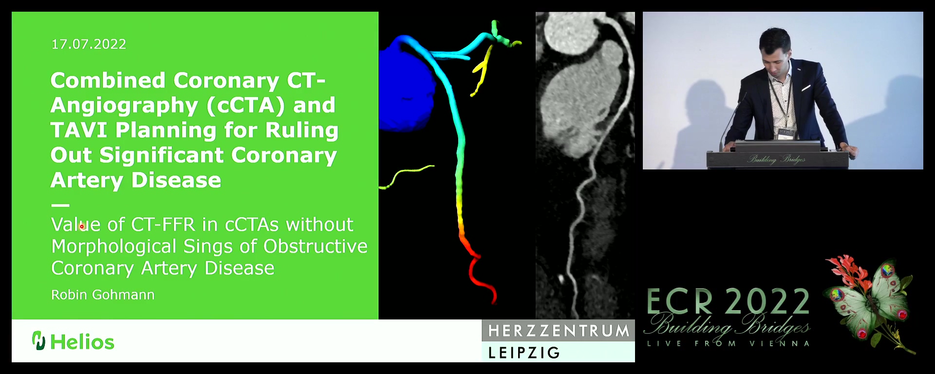 Combined Coronary CT-Angiography (cCTA) and TAVI planning: value of CT-FFR in cCTAs without morphological signs of obstructive coronary artery disease