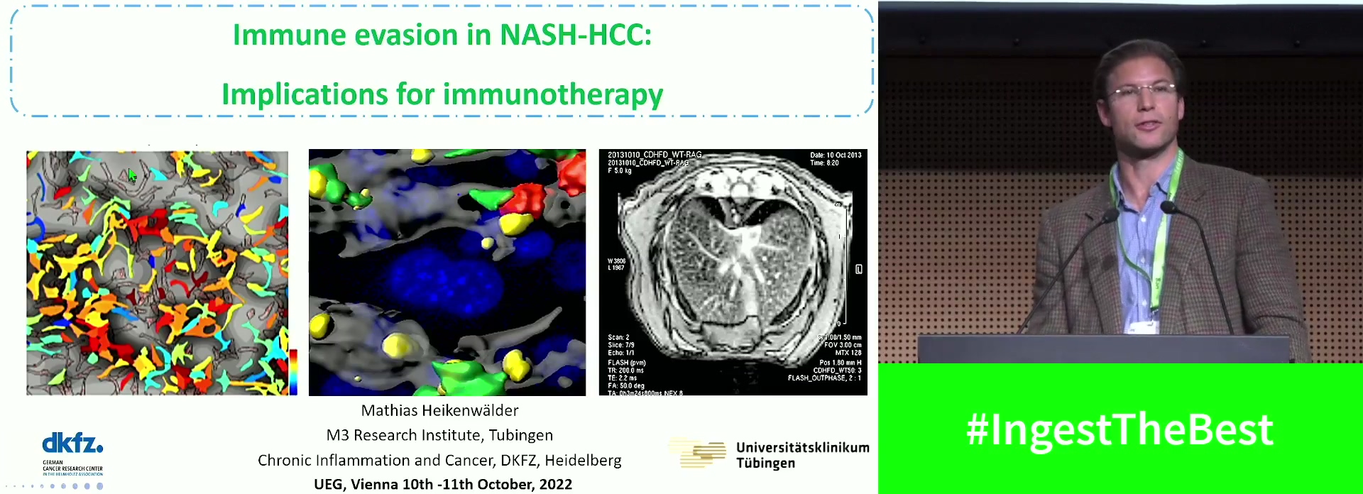 Immunevasion in NASH-HCC