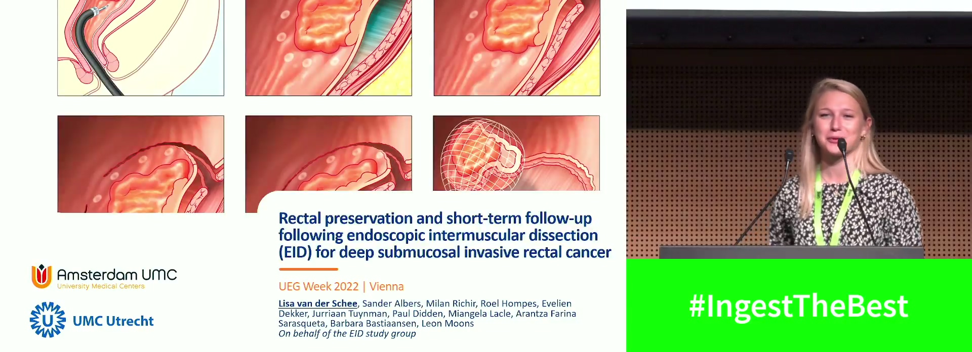 RECTAL PRESERVATION FOLLOWING ENDOSCOPIC INTERMUSCULAR DISSECTION (EID) FOR DEEP SUBMUCOSAL INVASIVE RECTAL CANCER: SHORT TO INTERMEDIATE-TERM FOLLOW-UP