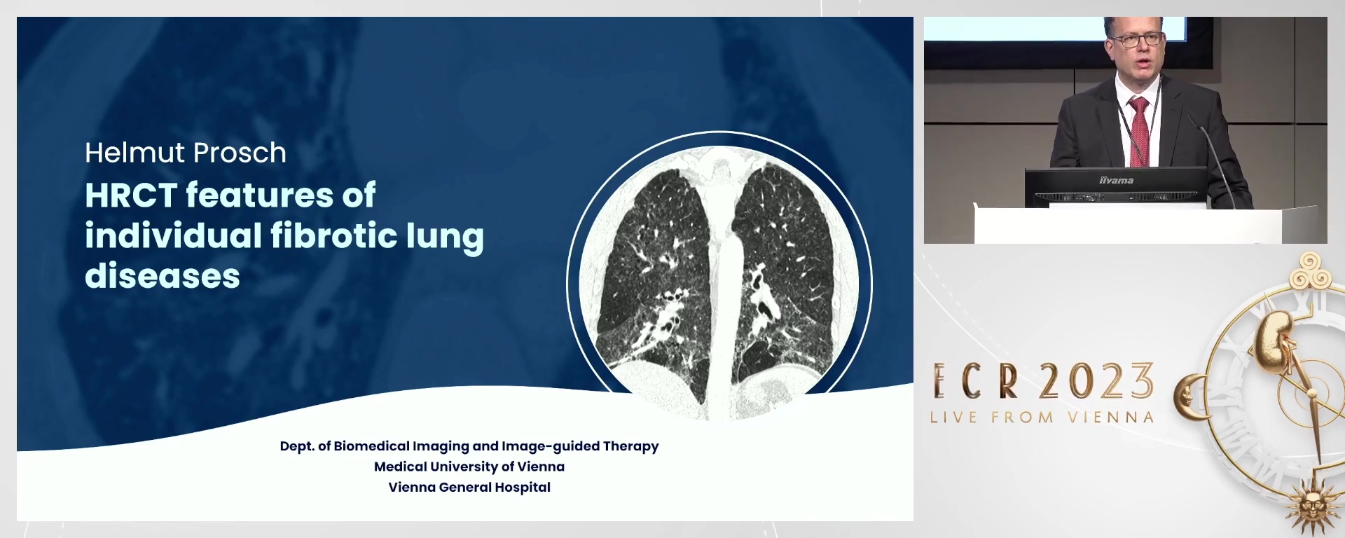 HRCT features of individual fibrotic lung diseases