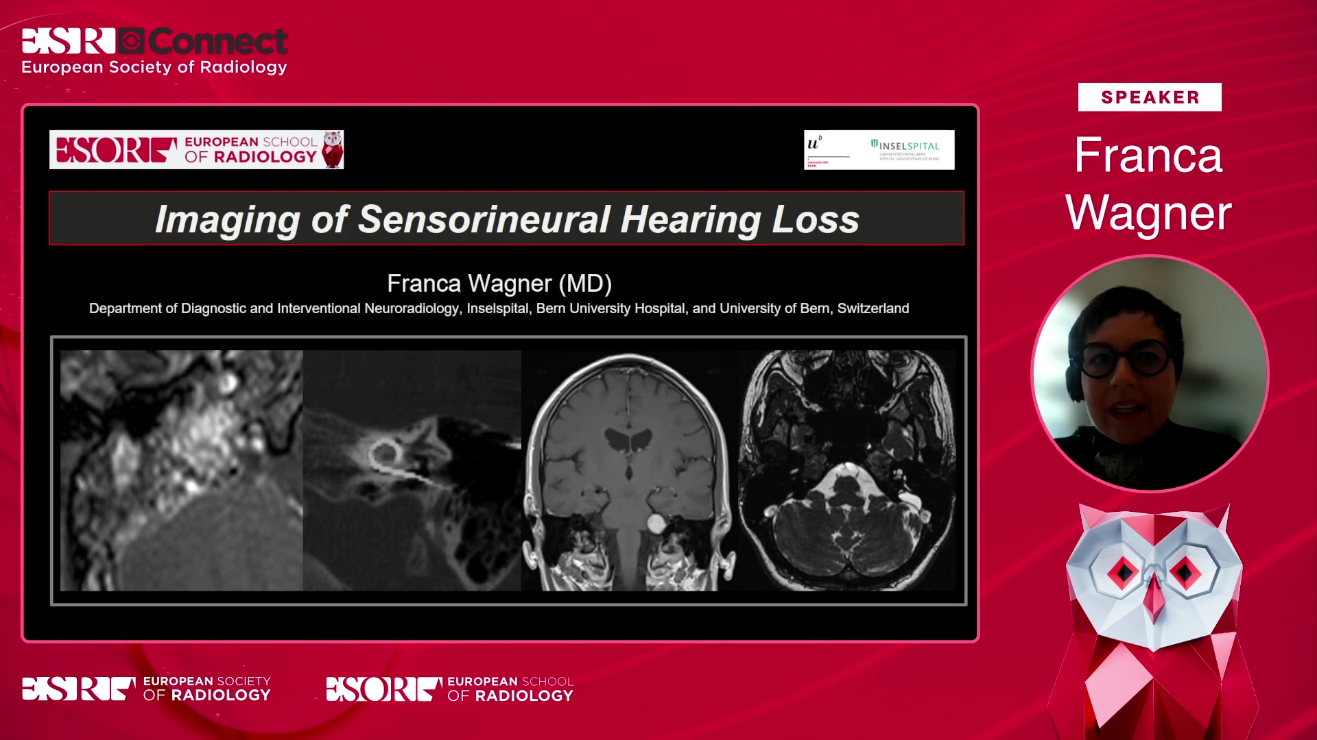 Imaging of sensorineural hearing loss
