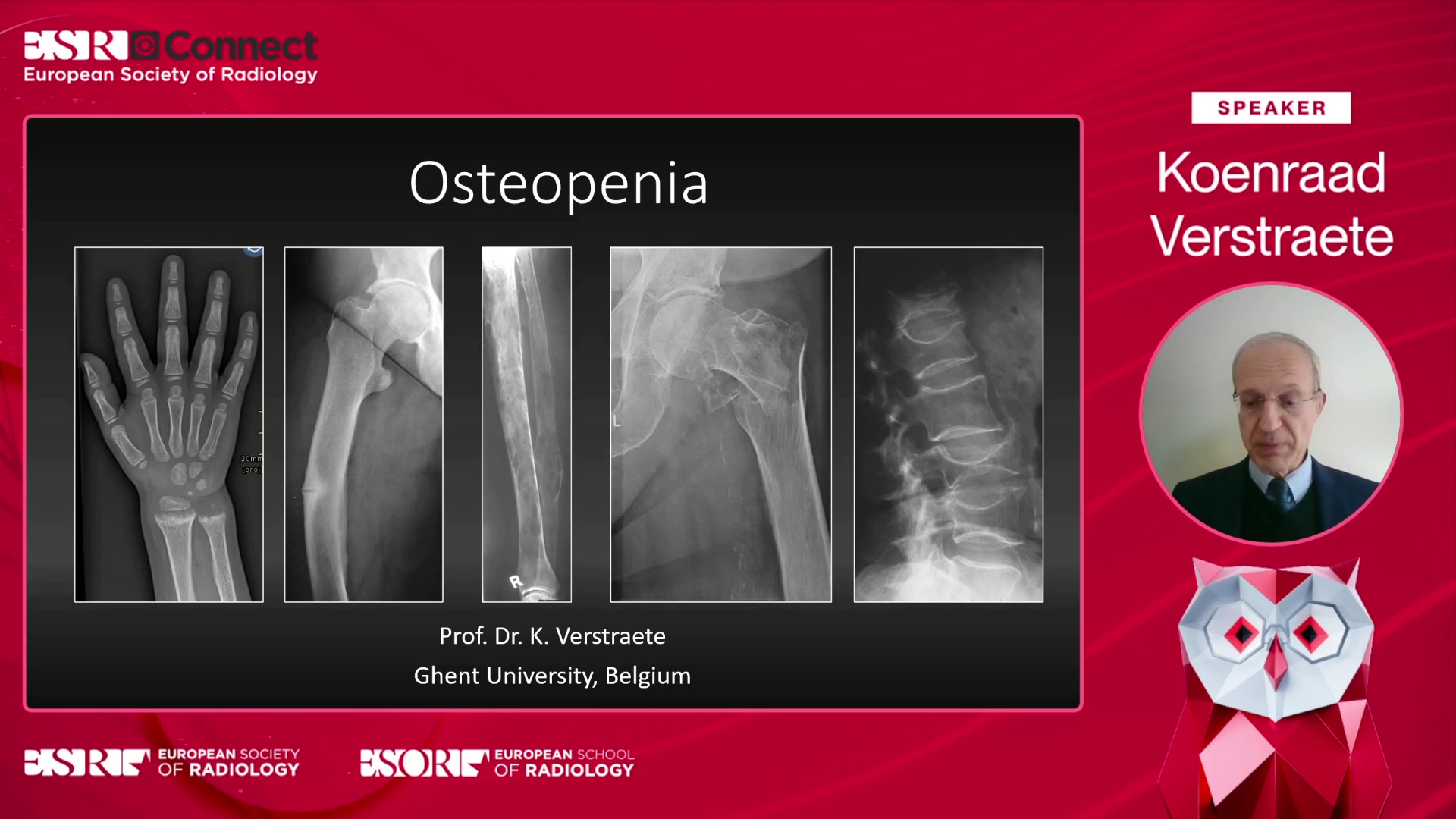 Osteopenia