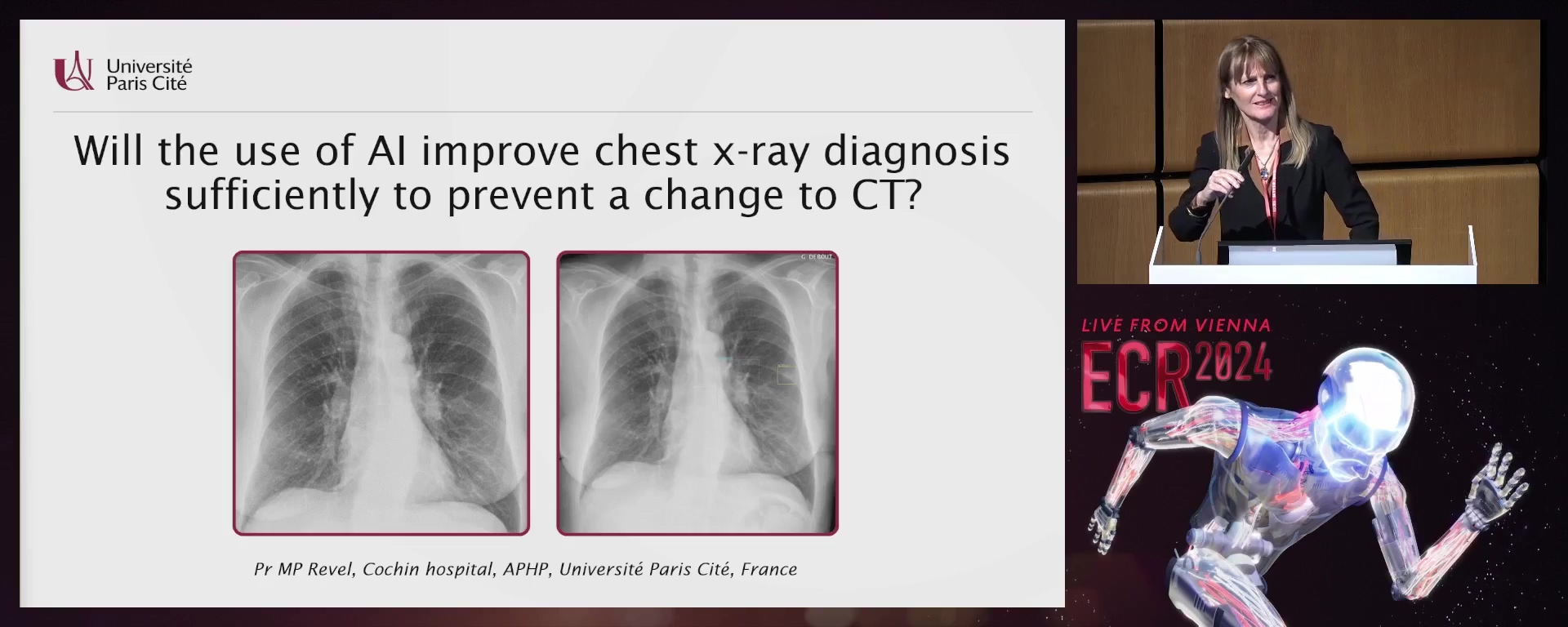 Will the use of AI improve chest x-ray diagnosis sufficiently to prevent a change to CT?