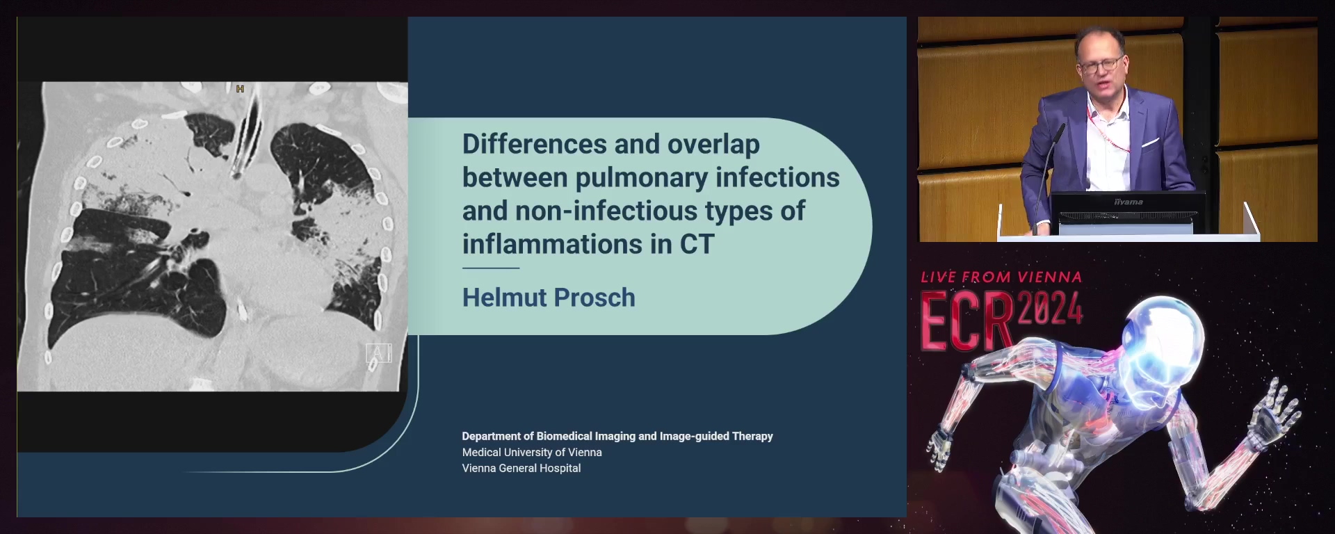 Differences and overlap between pulmonary infections and non-infectious types of inflammations in HRCT