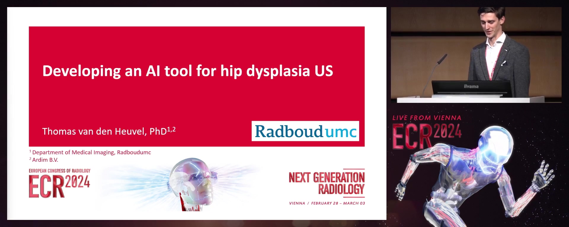 Developing an AI tool for hip dysplasia US