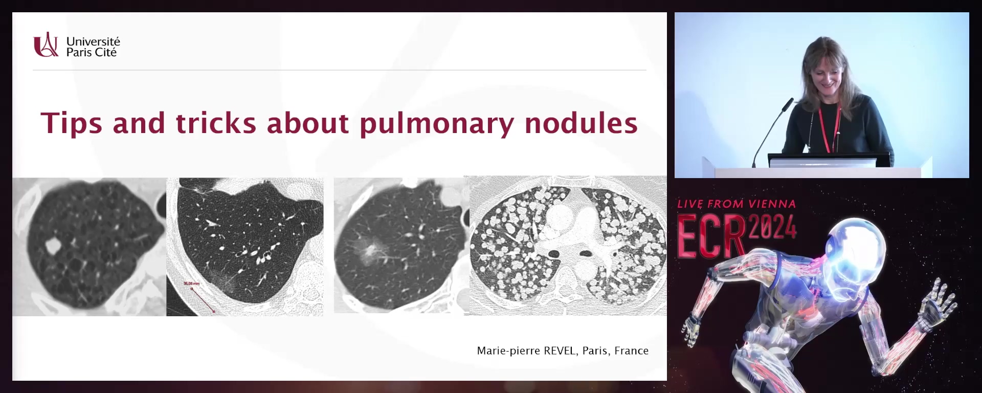 Tips and tricks about pulmonary nodules