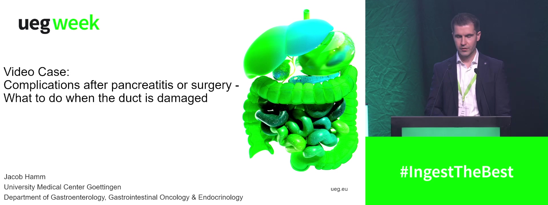 Video Case: Complications after pancreatitis or surgery - What to do when the duct is damaged?