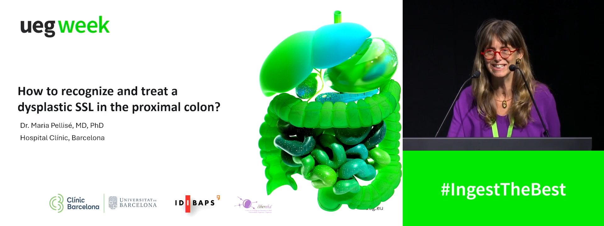 How to recognise and treat a dysplastic SSL in the proximal colon?