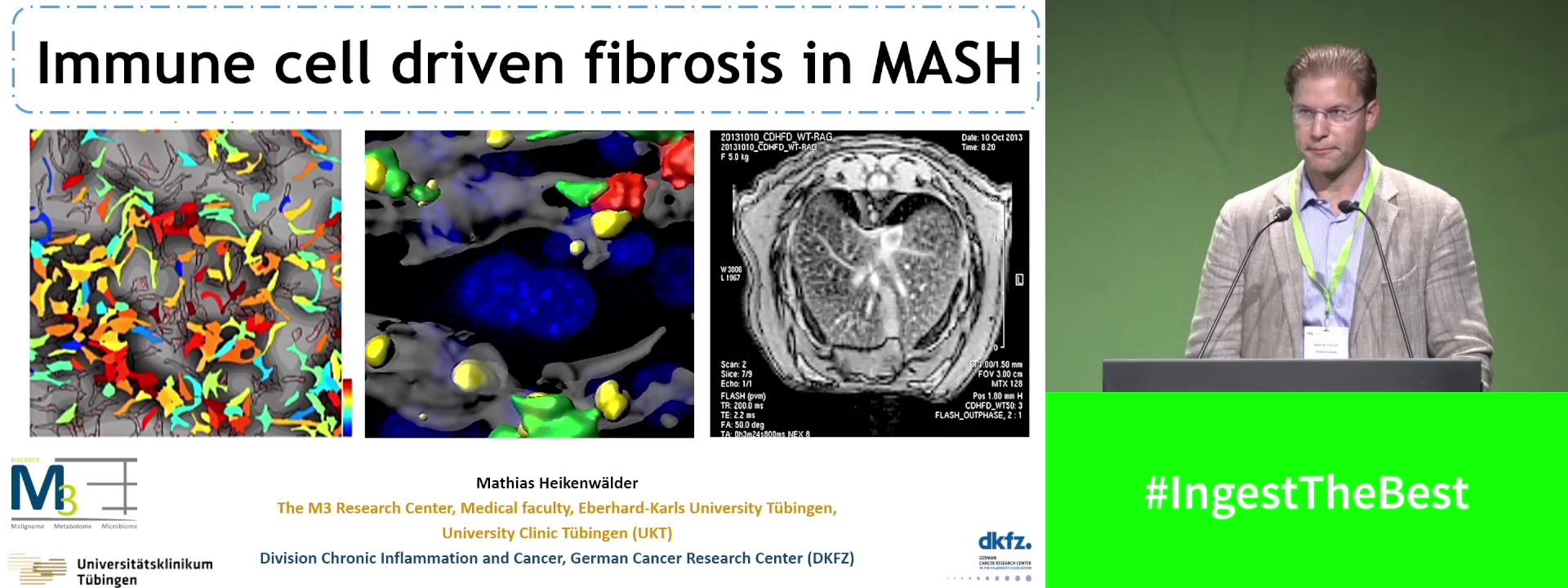 Immune-cell-driven fibrosis in NASH