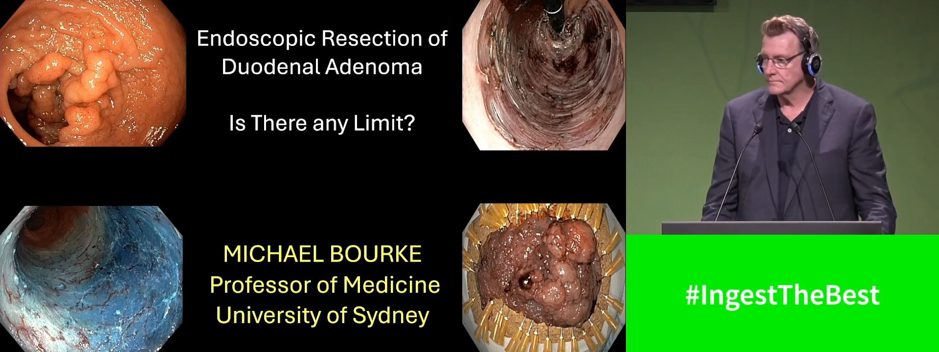 Endoscopic resection of duodenal polyps: Is there any limit?