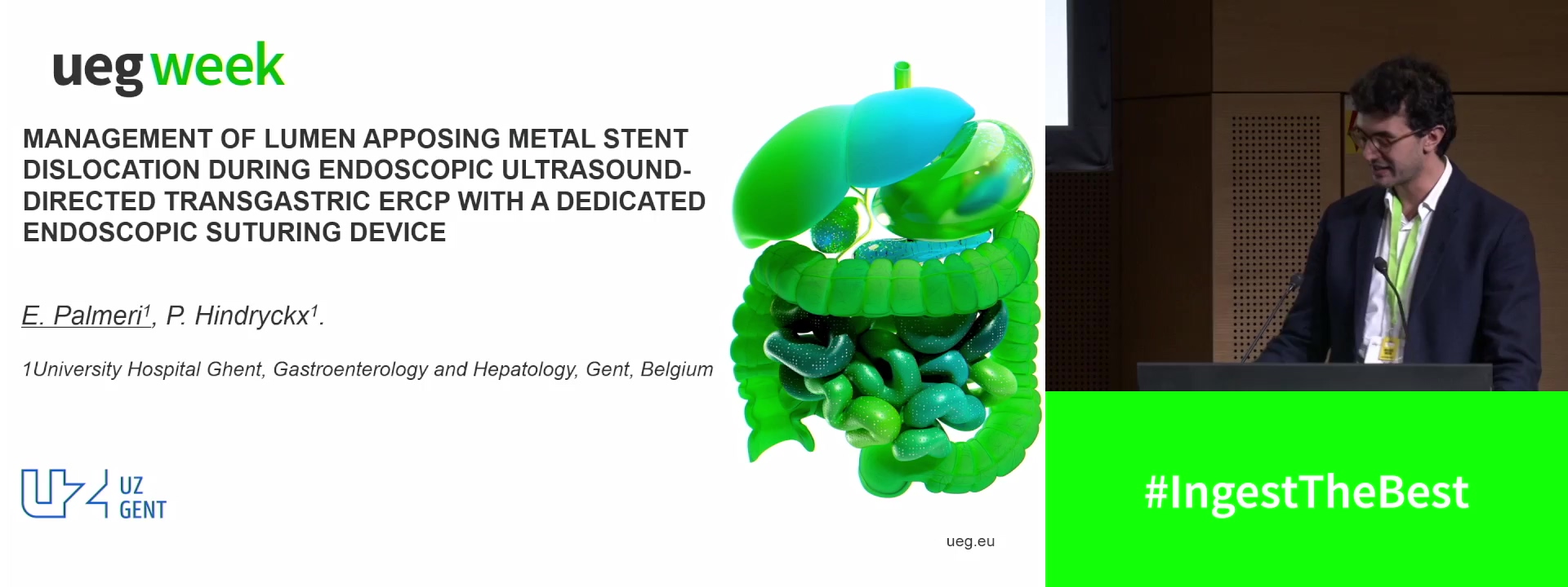 MANAGEMENT OF LUMEN APPOSING METAL STENT DISLOCATION DURING ENDOSCOPIC ULTRASOUND-DIRECTED TRANSGASTRIC ERCP WITH A DEDICATED ENDOSCOPIC SUTURING DEVICE