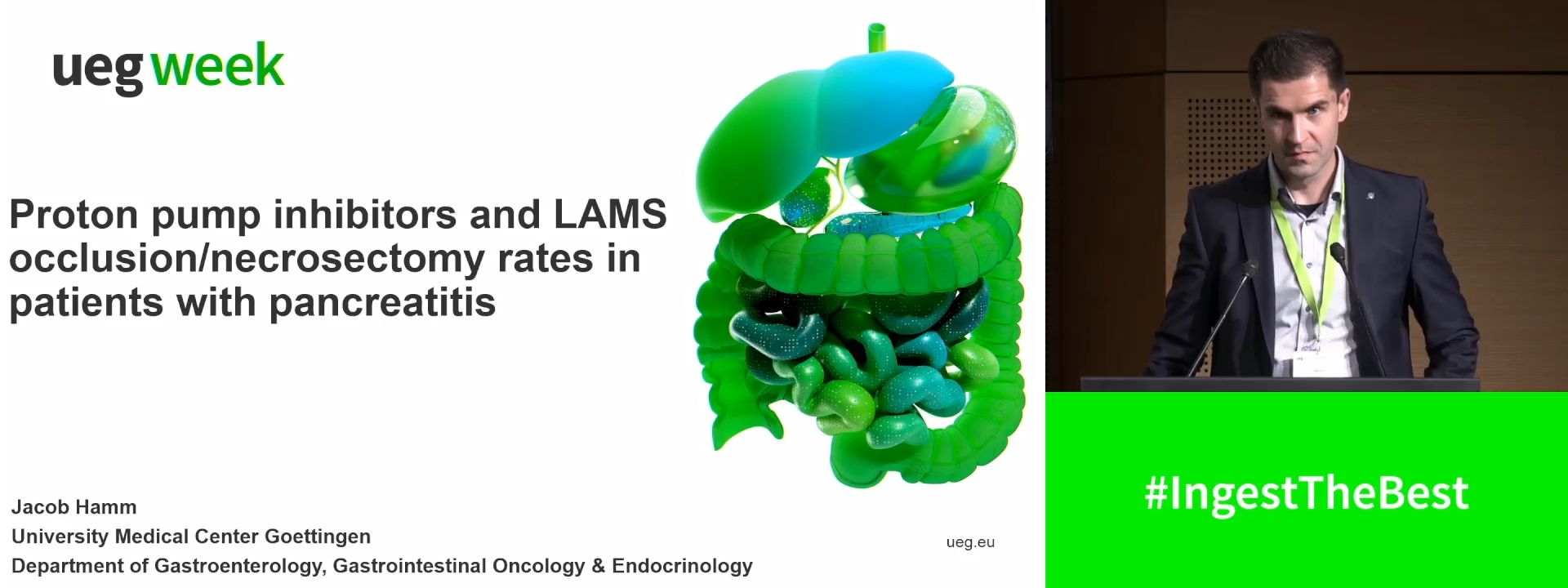 PROTON PUMP INHIBITORS ARE ASSOCIATED WITH INCREASED LAMS OCCLUSION RATE AND A HIGHER NUMBER OF REQUIRED ENDOSCOPIC NECROSECTOMIES IN PATIENTS WITH PANCREATITIS