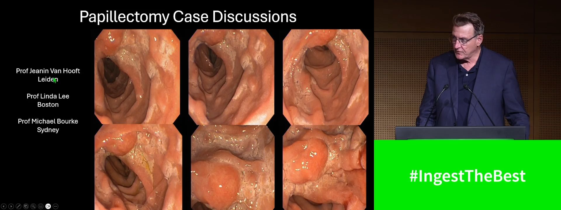 Precancerous ampullary lesions (Complete Session)