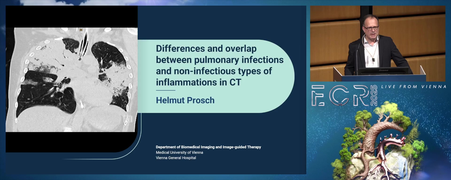 Differences and overlap between pulmonary infections and inflammations in HRCT