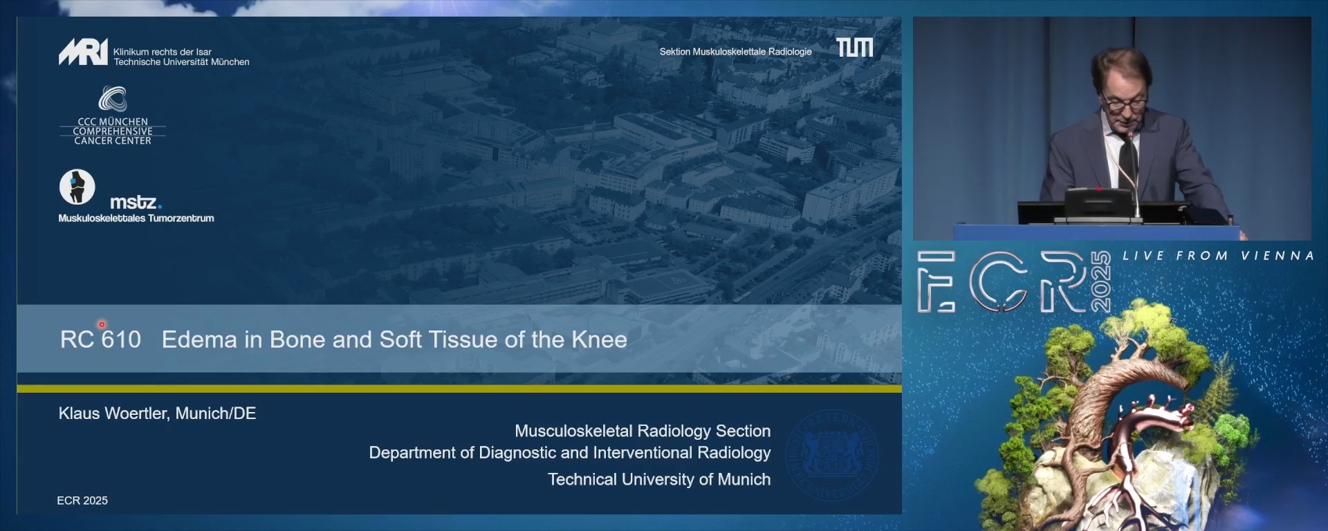 Oedema in bone and soft tissues of the knee