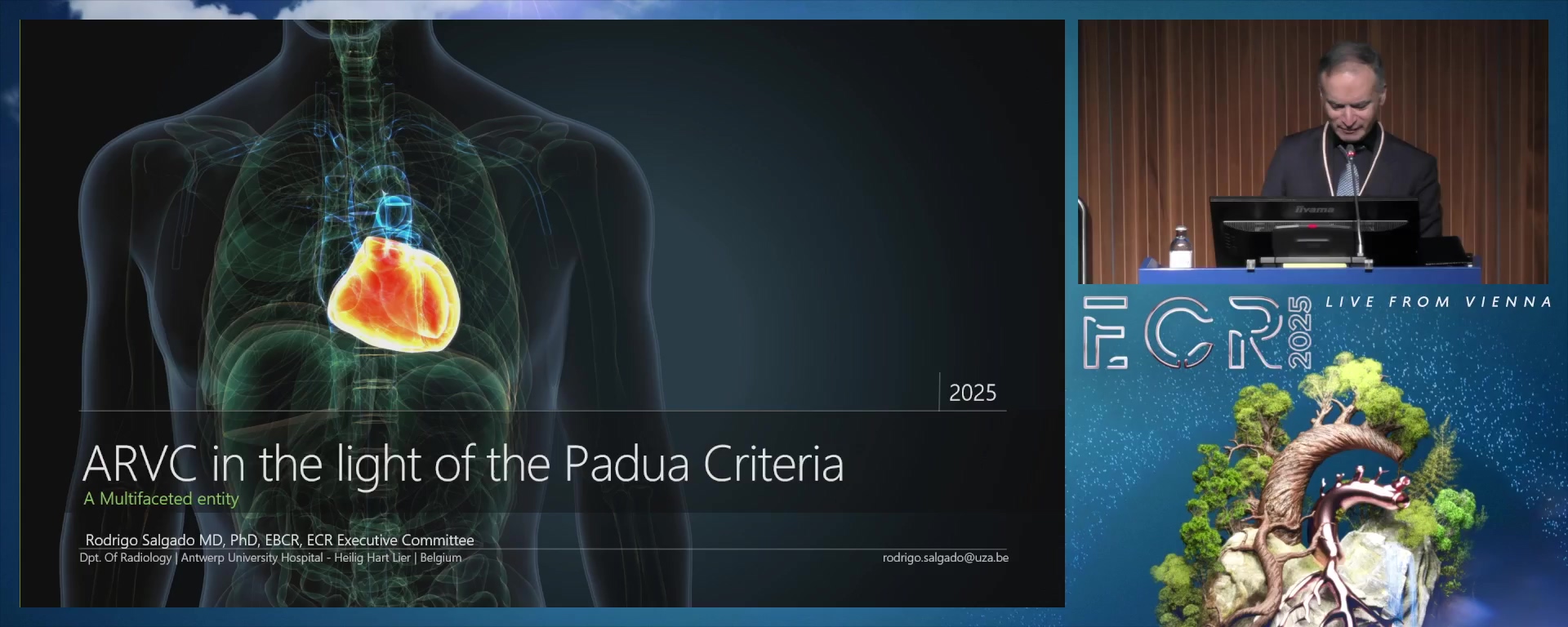 Arrhythmogenic ventricular cardiomyopathy in the light of the PADUA criteria