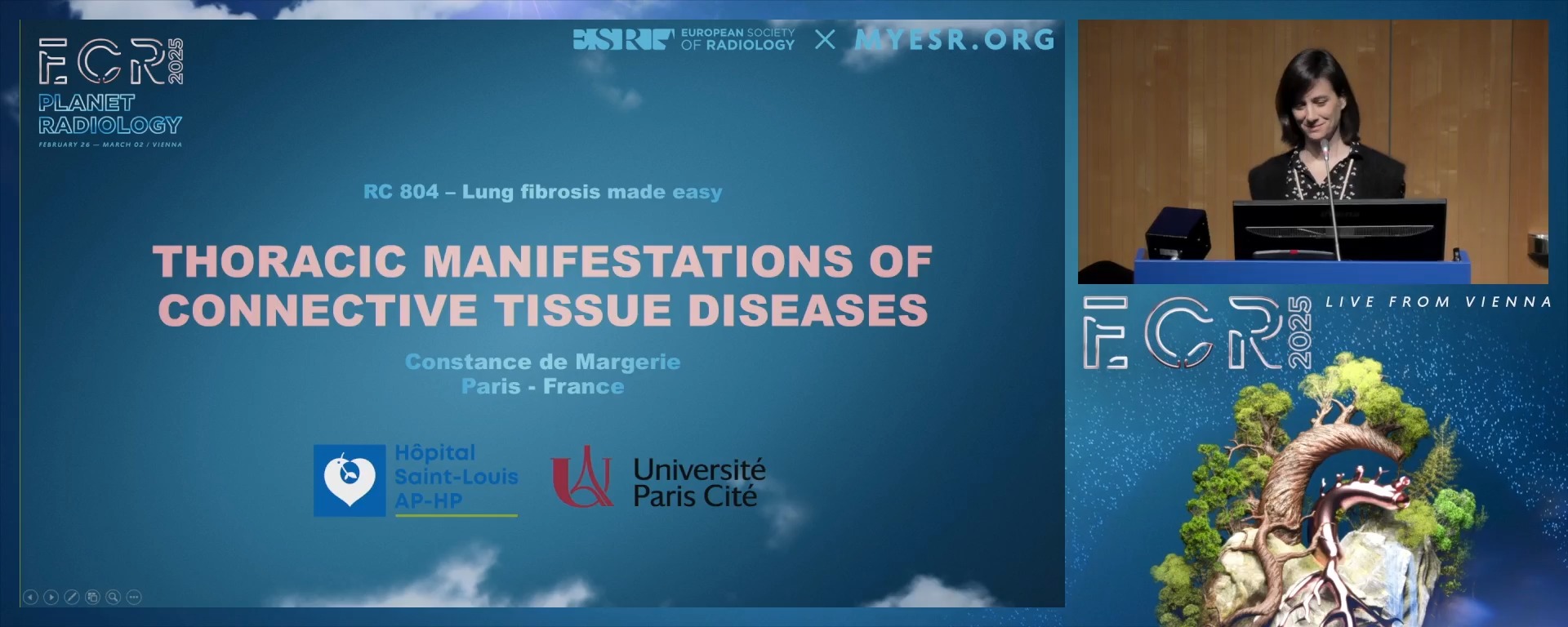 Thoracic manifestations of connective tissue diseases