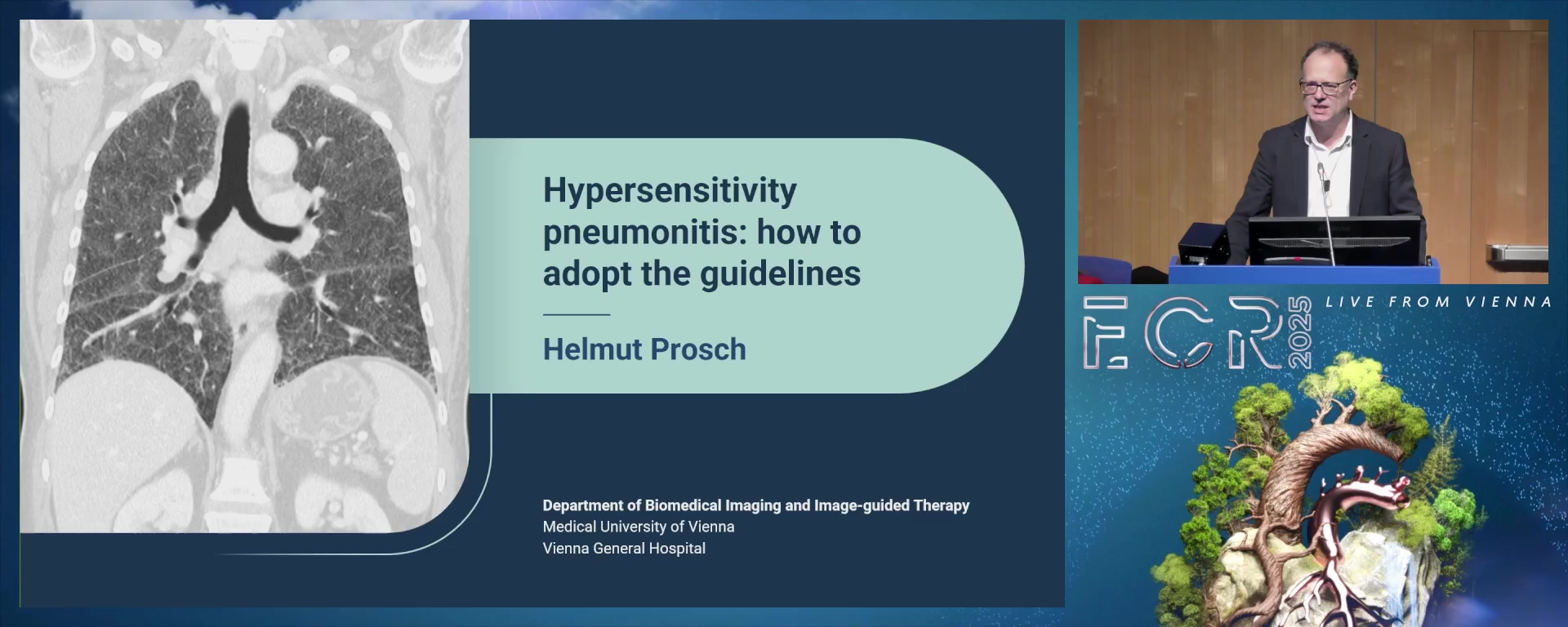 Hypersensitivity pneumonitis: how to adopt the guidelines
