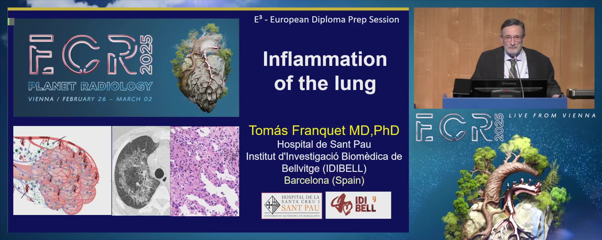 Inflammation of the lung
