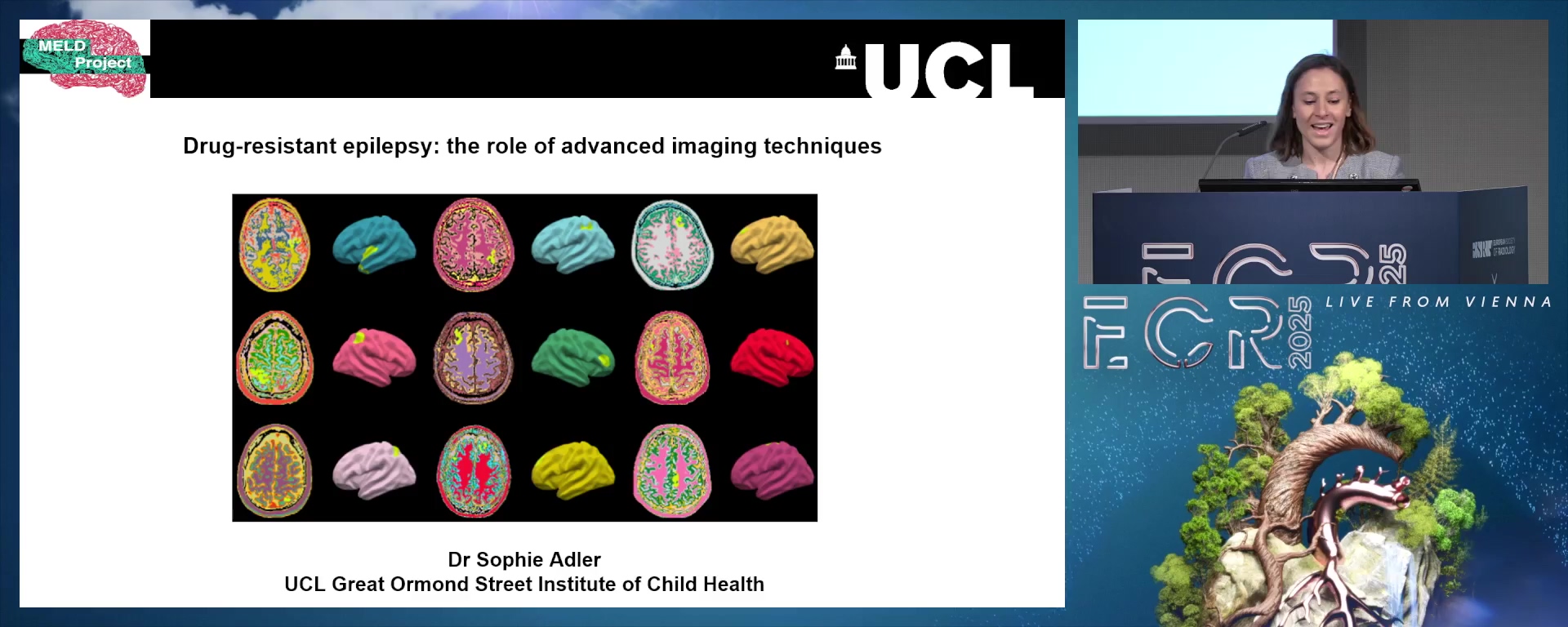 Drug-resistant epilepsy: the role of advanced imaging techniques