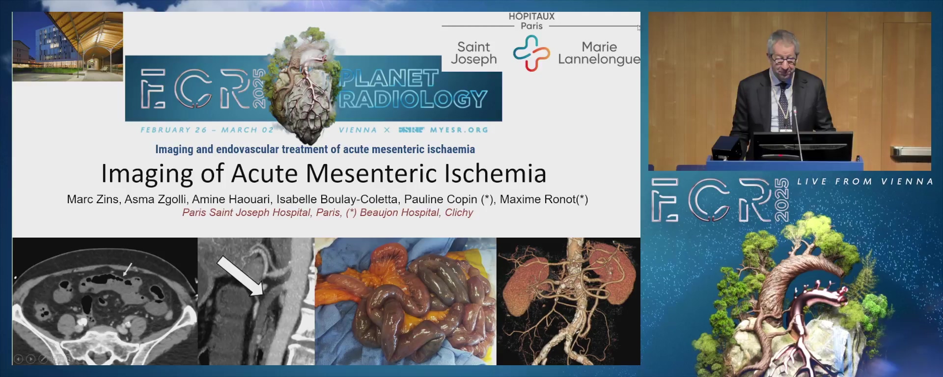 Imaging of acute mesenteric ischaemia