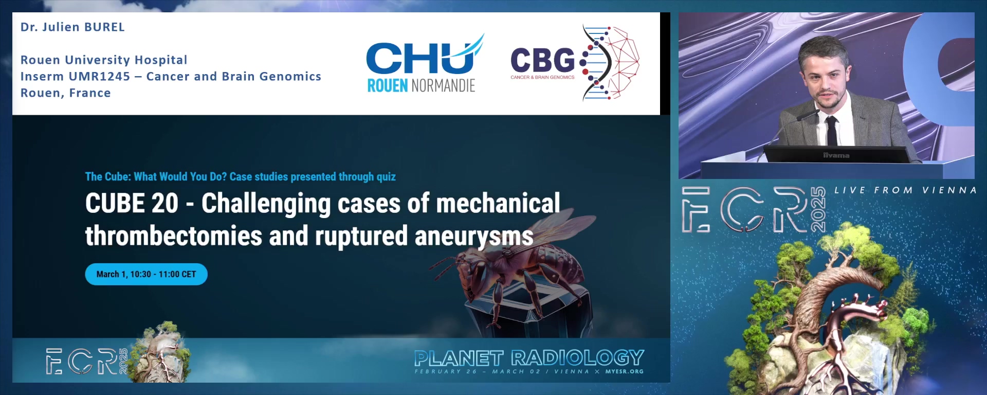 Challenging cases of mechanical thrombectomies and ruptured aneurysms