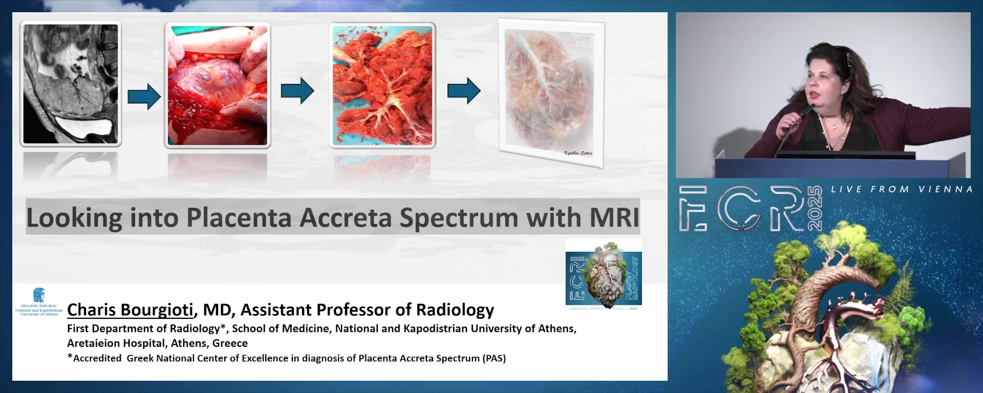 Looking into placenta accreta spectrum with MRI
