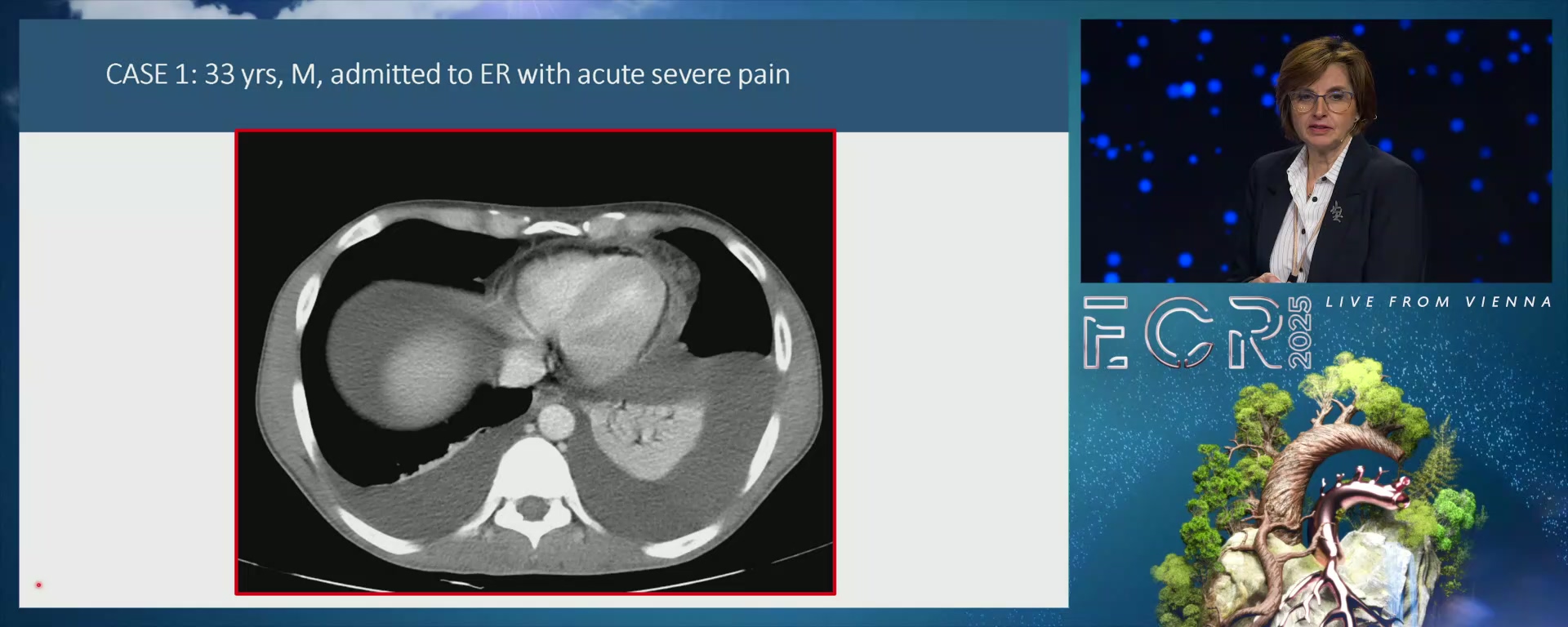 Panel discussion: Case review: top tips for imaging the acute abdomen