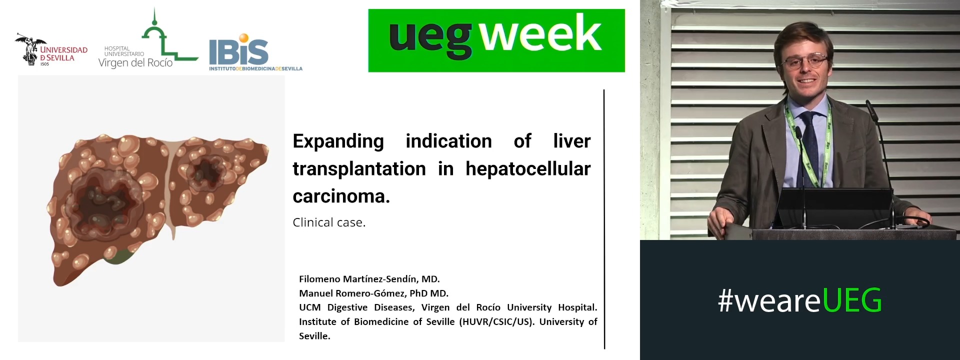Expanding indication of liver transplantation in HCC