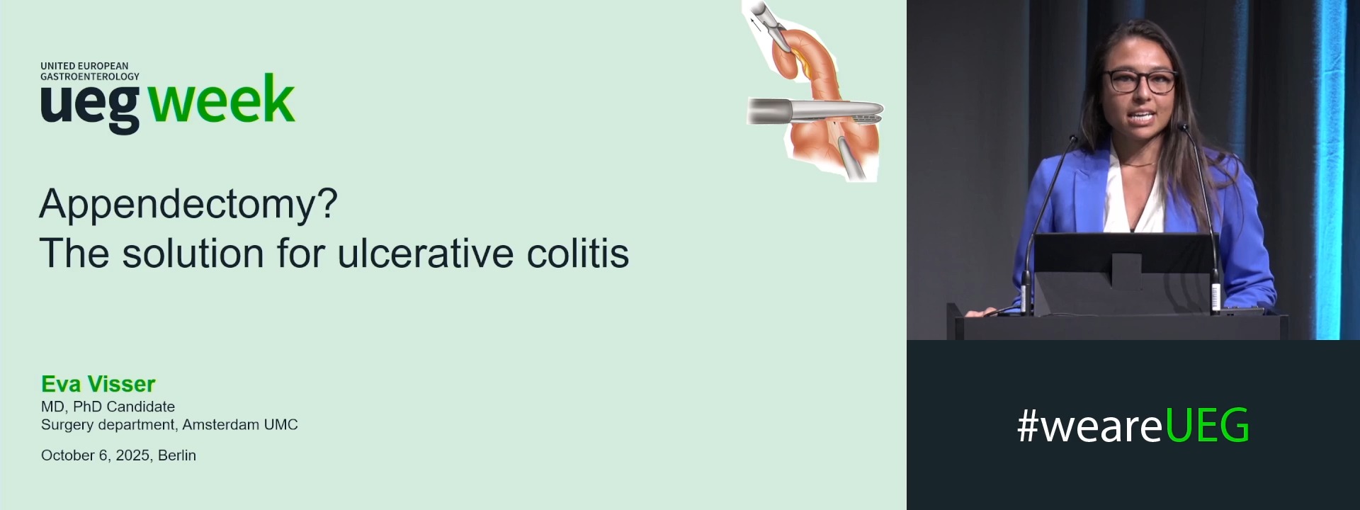 Appendectomy? The solution for ulcerative colitis