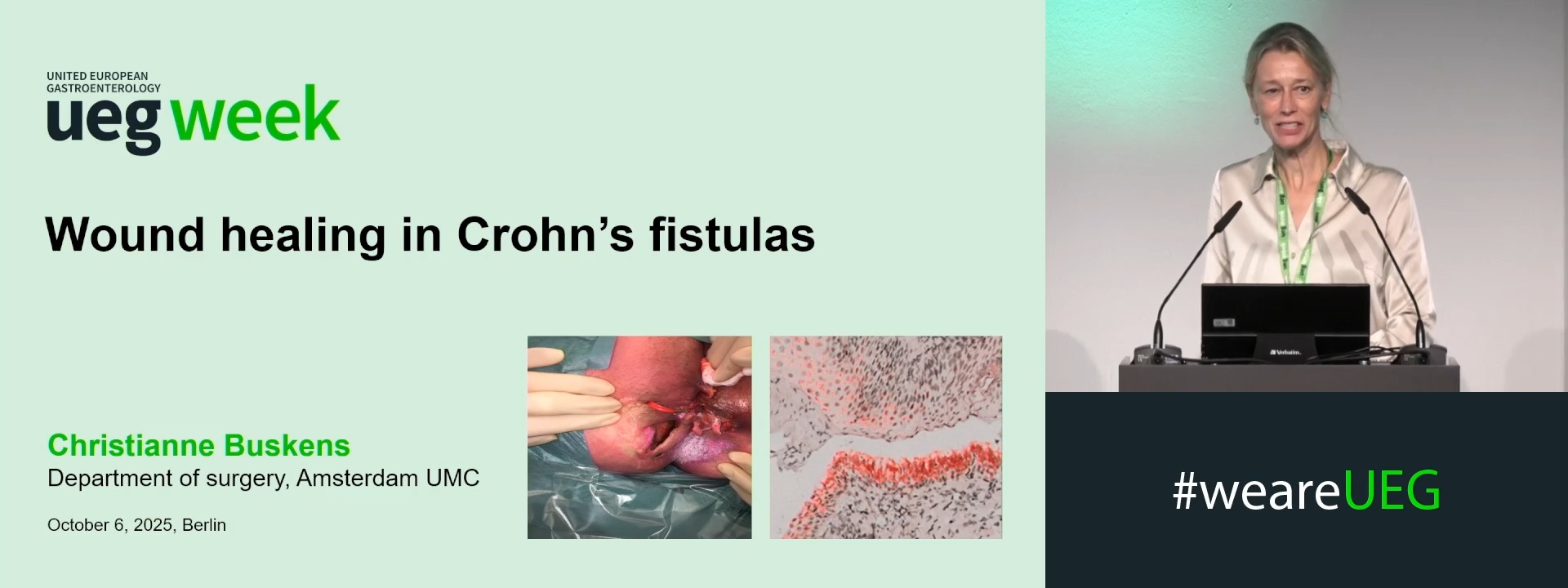 Wound healing in fistula and surgical wounds