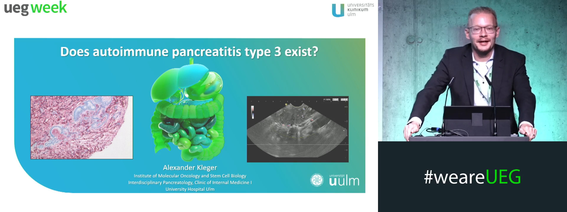 Does autoimmune pancreatitis type III exist?