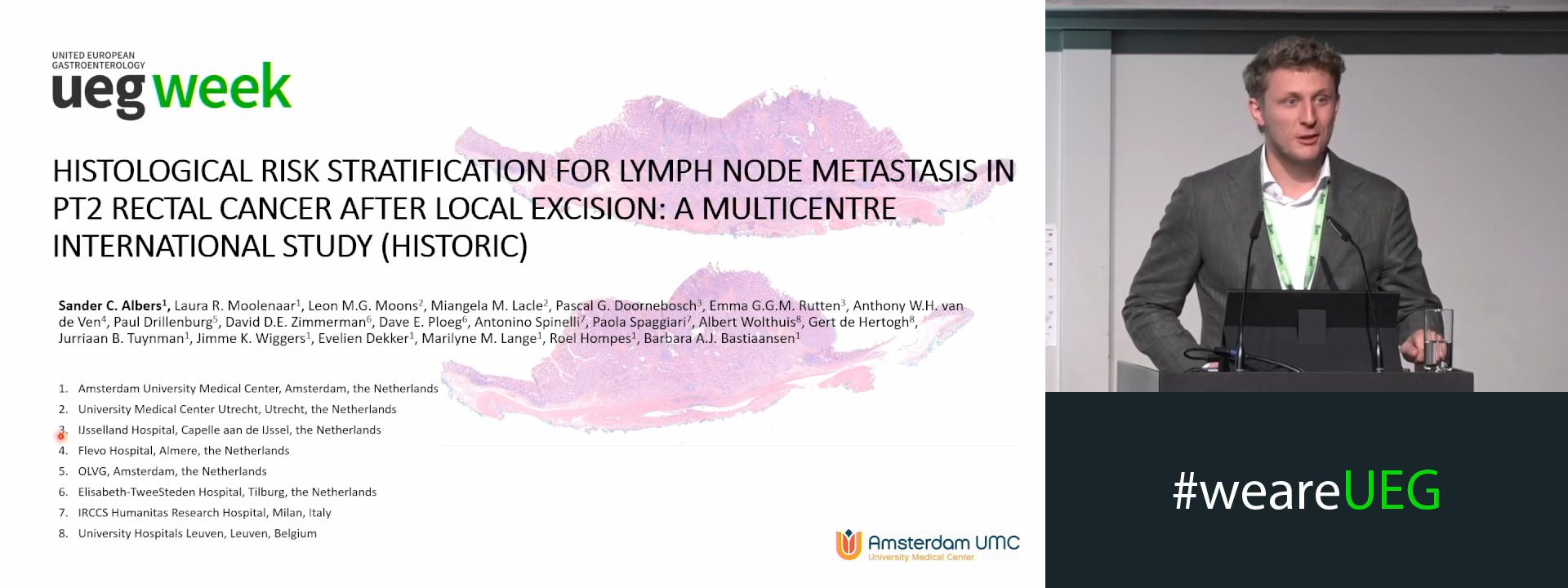 HISTOLOGICAL RISK STRATIFICATION FOR LYMPH NODE METASTASIS IN PT2 RECTAL CANCER AFTER LOCAL EXCISION: A MULTICENTRE INTERNATIONAL STUDY
