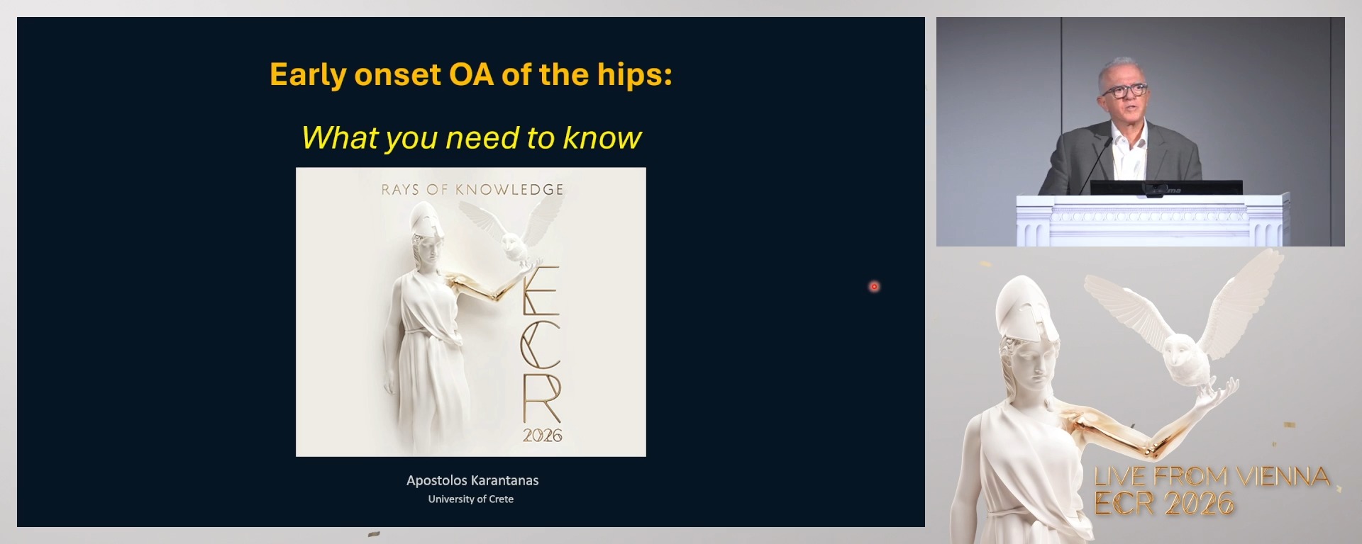 Early onset osteoarthritis: what you need to know