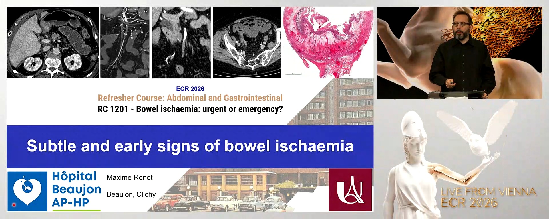 Subtle and early signs of bowel ischaemia