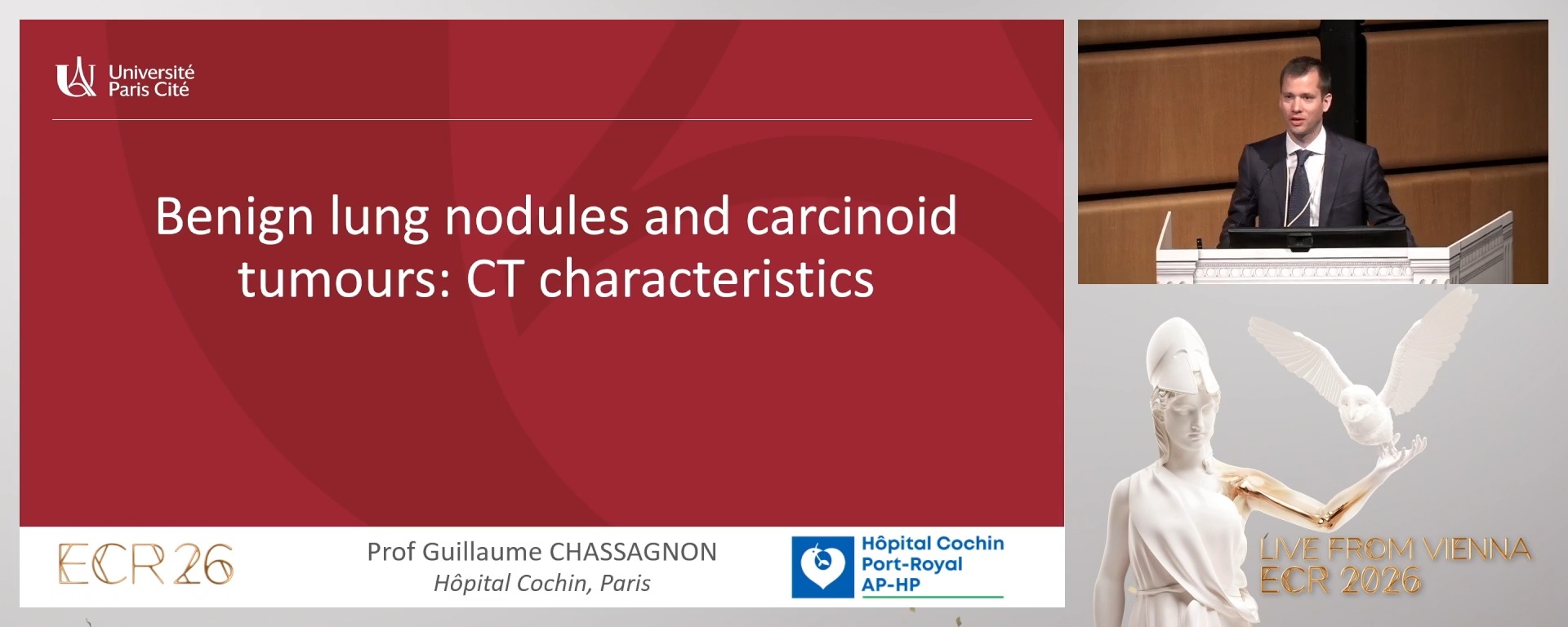 Benign lung nodules and carcinoid tumours: CT characteristics
