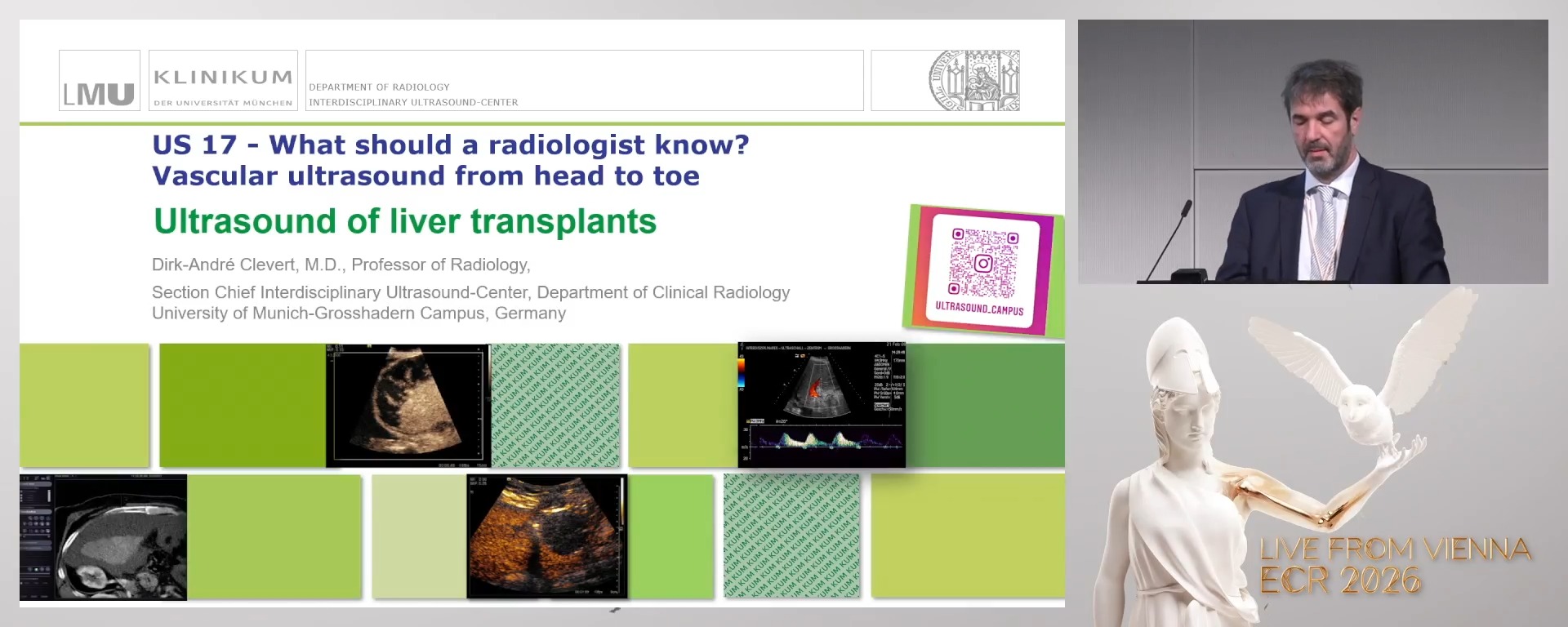 Ultrasound of liver transplants