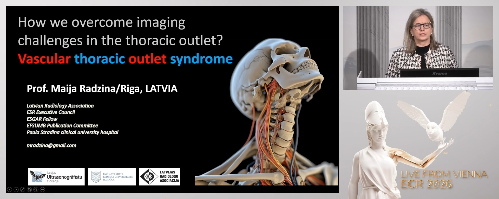 Vascular thoracic outlet syndrome (TOS)